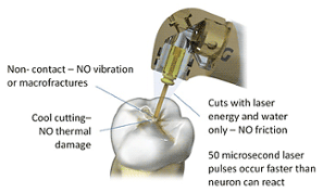 Waterlase Dental Treatment