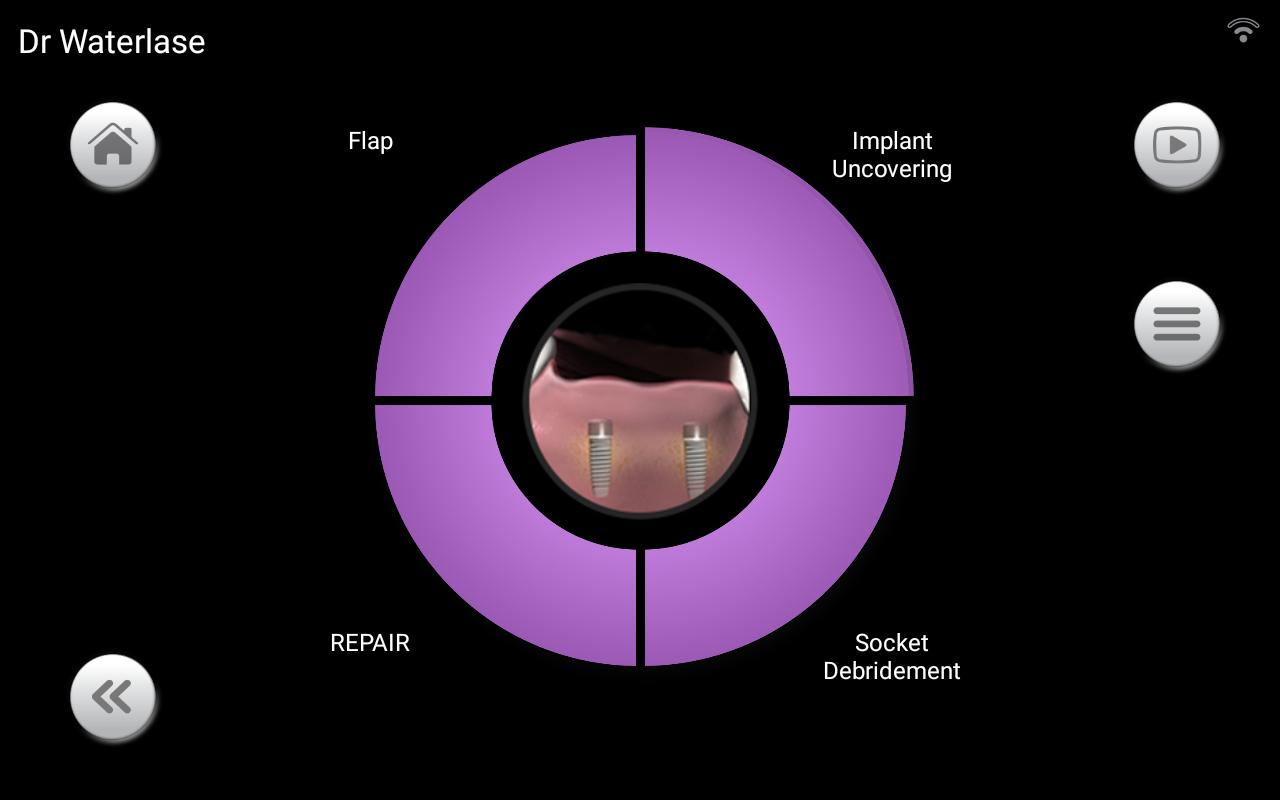 Waterlase iPlus Premier Edition - Implants