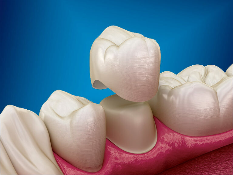 Crown & Veneer Protocol Guidebook Waterlase Dentistry