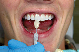 Epic X - 20 min Tooth Whitening