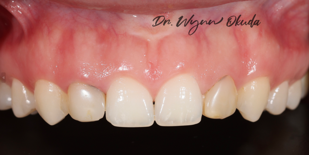 Porcelain veneers - before