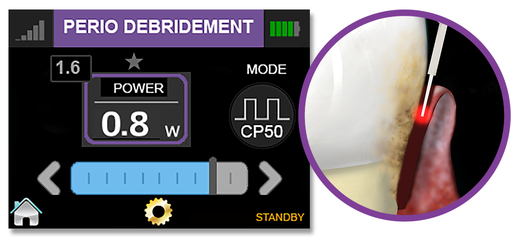 Epic Hygiene Perio Debridement