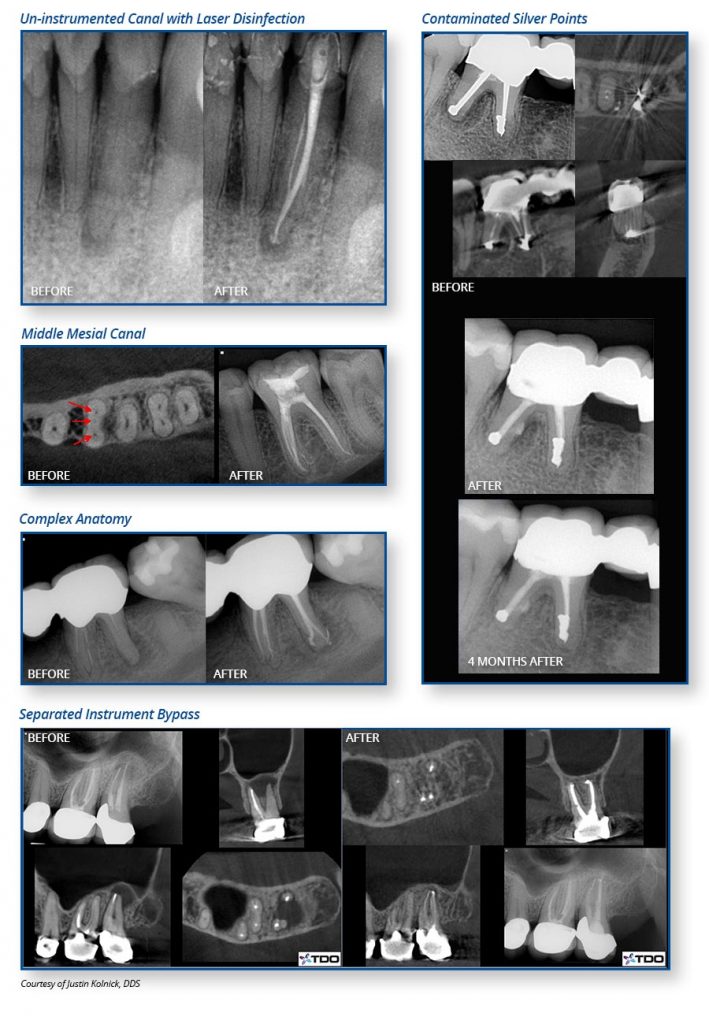 Waterlase Endodontics - Courtesy of Justin Kolnick, DDS