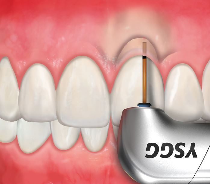 Waterlase Crown Lengthening Protocol