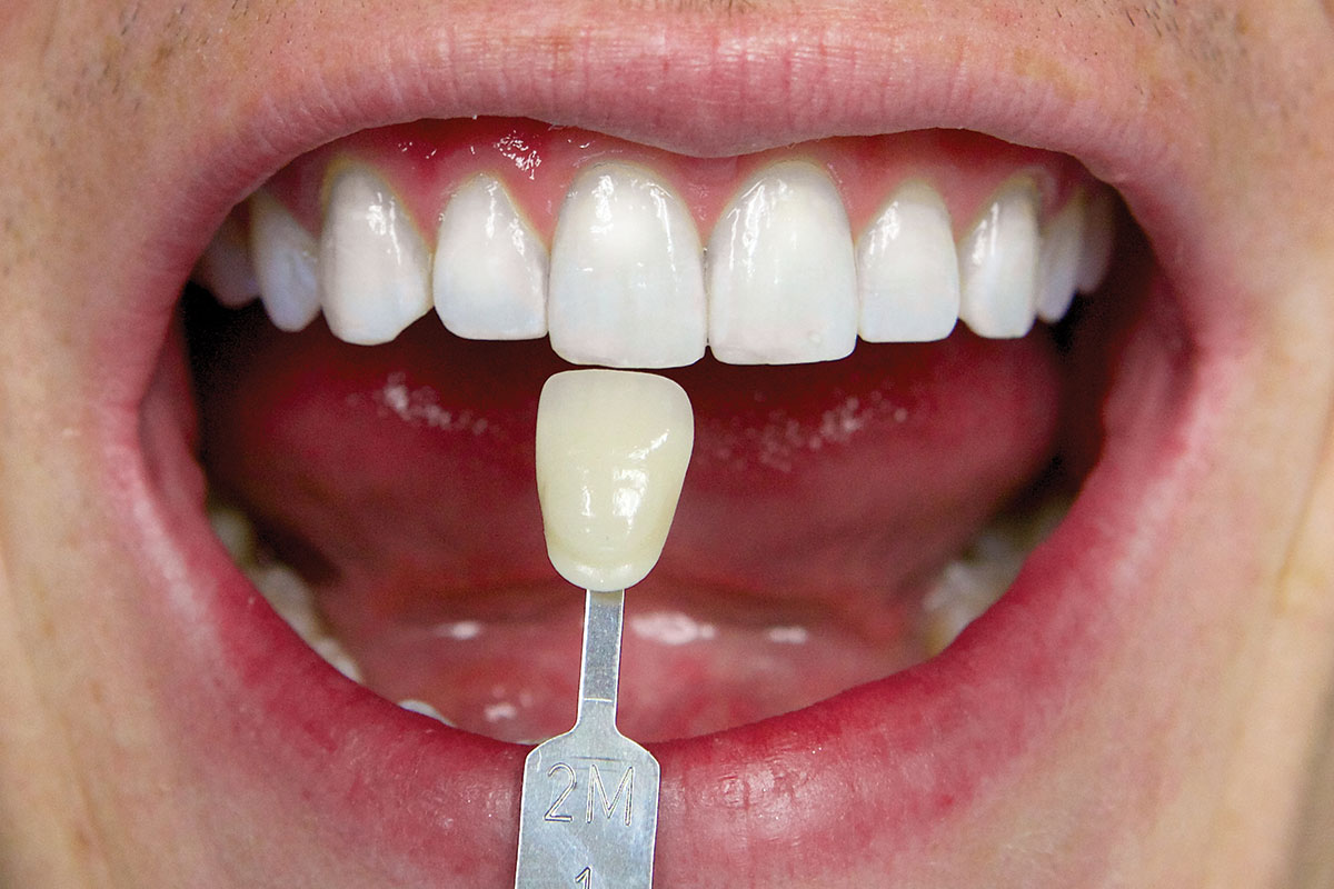 zoom teeth whitening groupon zoom teeth whitening groupon