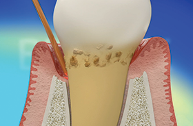 Waterlase Dentistry - REPAIR Perio Protocol