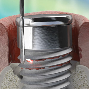 Waterlase Implant Therapy