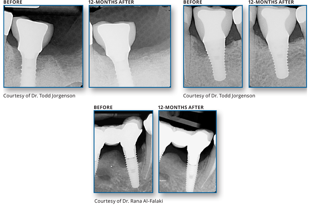 REPAIR Implant