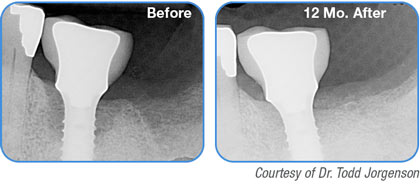 REPAIR Implant - Courtesy of Dr. Todd Jorgenson