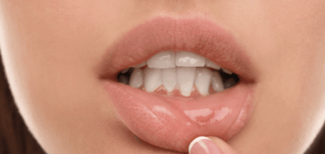 Canker Sore