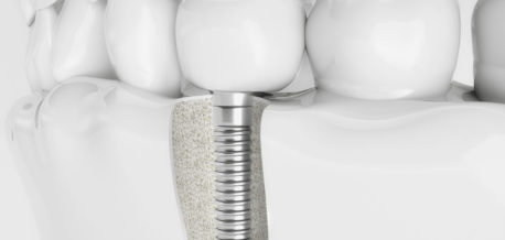 Dental Implants