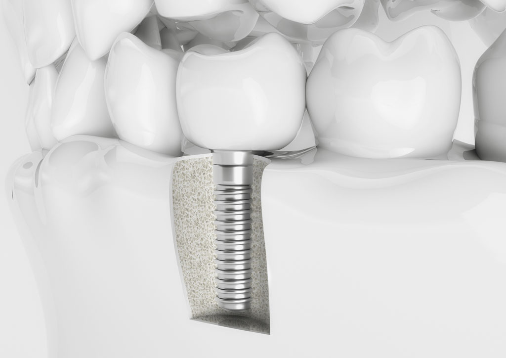 Top Ten Most Common Questions About Dental Implants BIOLASE