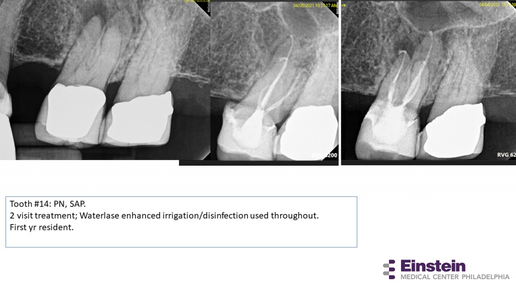Making an Impact Our Experience with Dental Lasers at Einstein’s