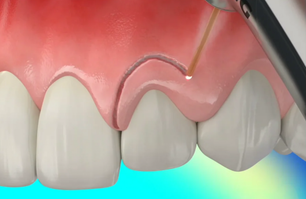 gingivectomy-animation Gingivectomy with Waterlase