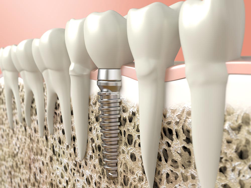 Dental Lasers for Successful Implant Placement BIOLASE