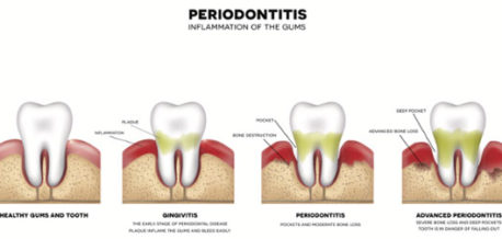 Inflammation Of The Gums