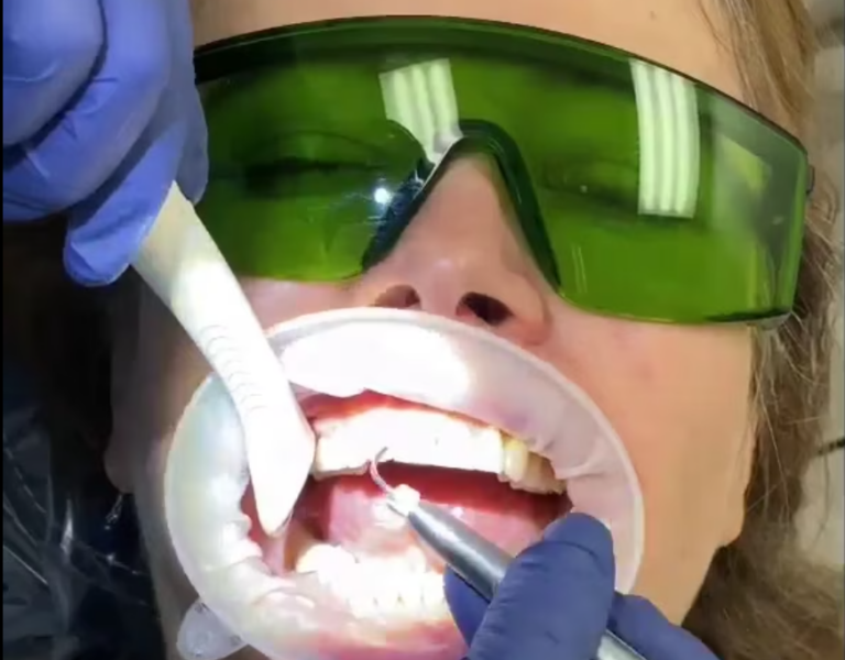 Laser Bacterial Reduction with Dental Lasers BIOLASE