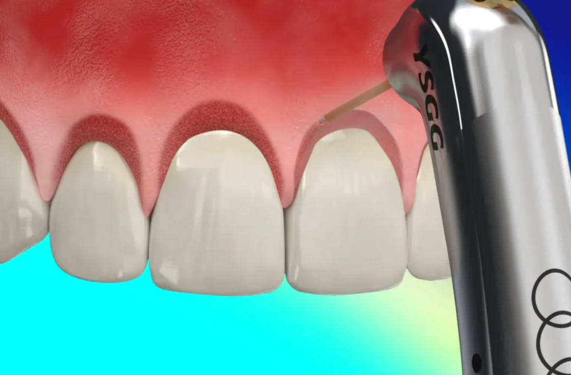 Teeth Lengthening with Waterlase