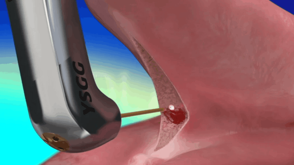 Waterlase Frenectomy