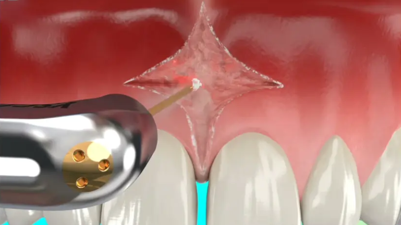 Maxillary Frenectomy with Waterlase