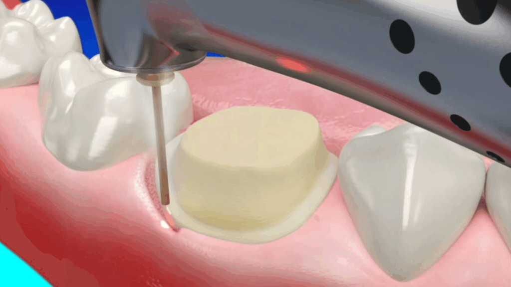 Osseous crown lengthening